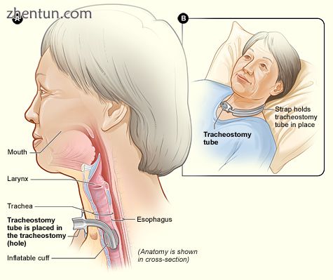 Figure A shows a side view of the neck and the correct placement of a tracheosto.jpg