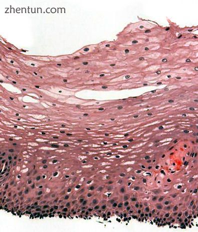 H&amp;E stain of a biopsy of the normal esophageal wall, showing the stratified sq.jpg