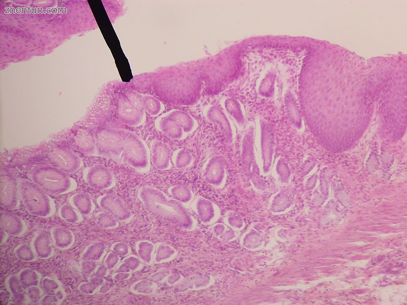 Histological section of the gastro-esophageal junction, with a black arrow indic.jpg