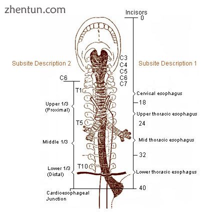 The esophagus is constricted in three places..jpg