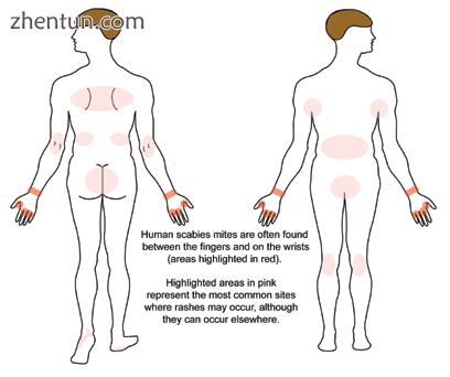 Commonly involved sites of rashes of scabies[15].png