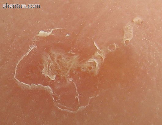 Magnified view of a burrowing trail of the scabies mite. The scaly patch on the left w.jpg