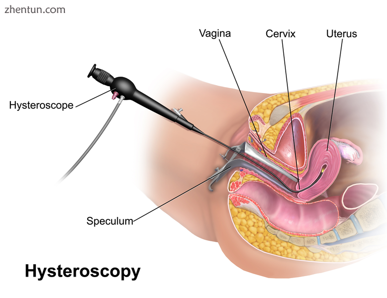 Anatomic depiction of a modern hysteroscopic procedure..png