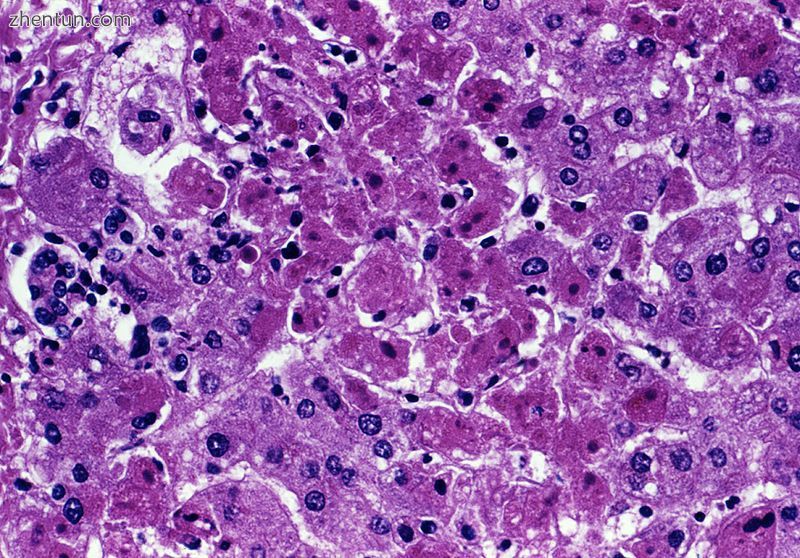 Acute liver failure (with hepatocellular necrosis and sinusoidal bleeding) from .jpg