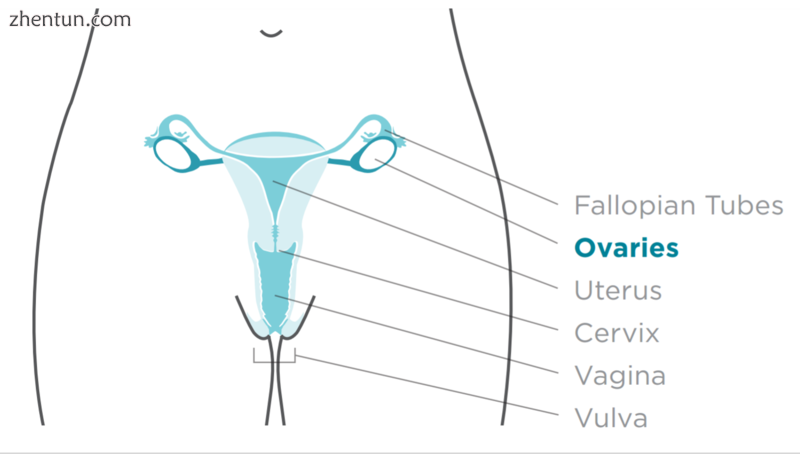 Site of ovarian cancer.png