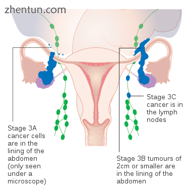 Stage 3 ovarian cancer.png