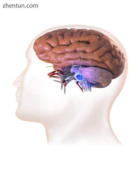 3D rendering of acoustic neuroma..png