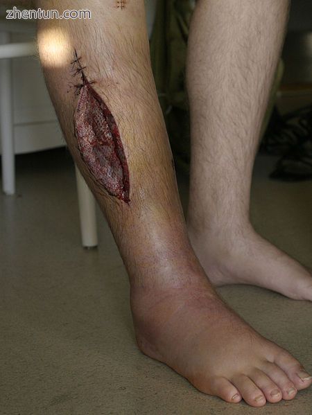 When the pressure is down, the fasciotomy is covered with a skin graft..jpg