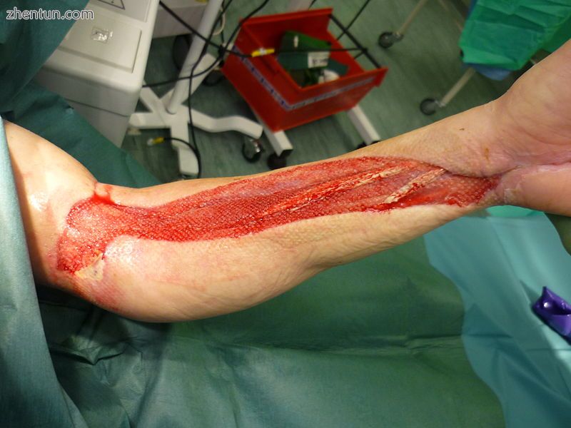 A forearm fasciotomy prior to skin grafting..jpg