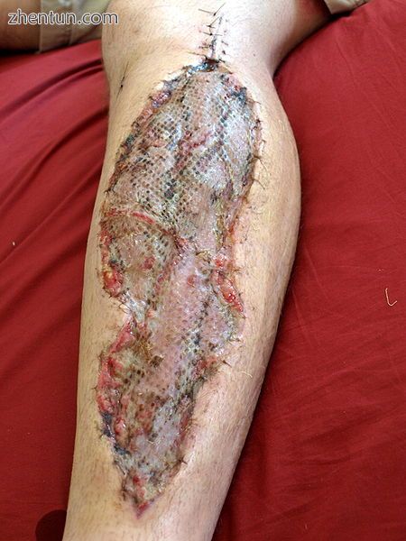 Wound covered with a skin graft once pressure is relieved..jpg
