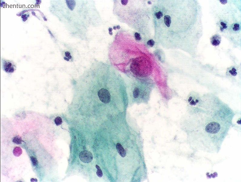 An obviously atypical cell can be seen.jpg