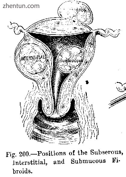 Diagram illustrating benign neoplasms, namely fibroids of the uterus.jpg