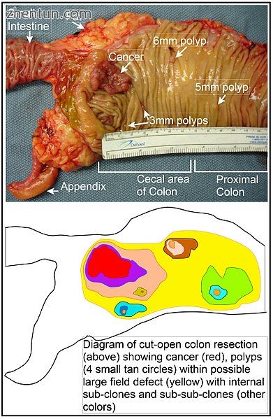 Longitudinally opened freshly resected colon segment.jpg