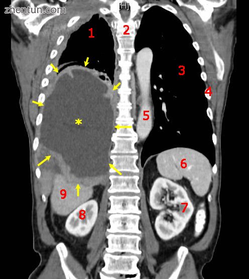 A coronal CT scan showing a malignant mesothelioma.jpg