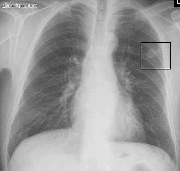 Chest x-ray showing lung cancer in the left lung.jpg
