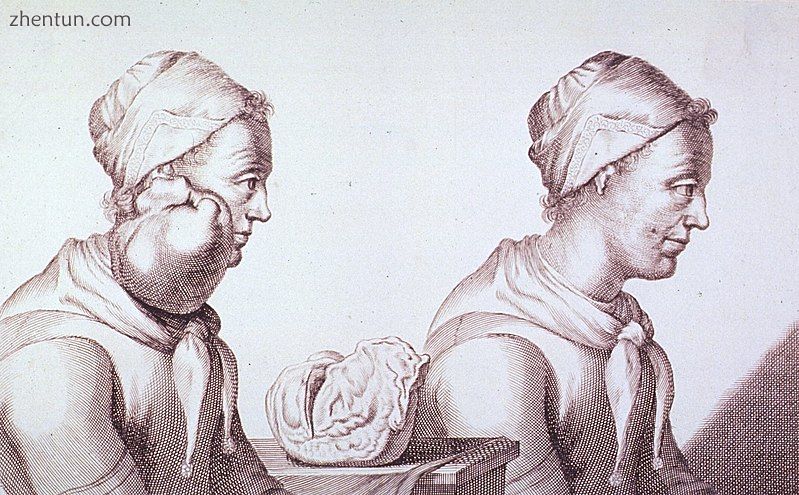 Engraving with two views of a Dutch woman who had a tumor removed from her neck .jpg