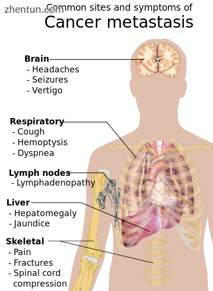 Symptoms of cancer metastasis depend on the location of the tumor..png