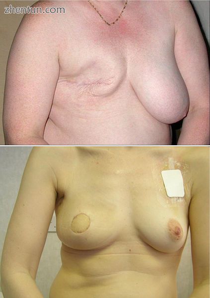 Conventional mastectomy (top); skin sparing mastectomy and latissimus dorsi myoc.jpg