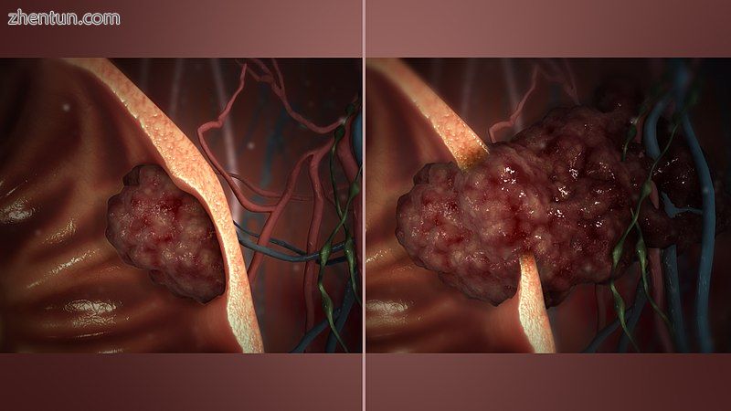 Benign (L) vs Malignant tumor (R)..jpg