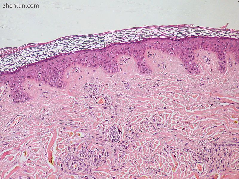 Normal Epidermis and Dermis with Intradermal Nevus 10x-cropped.JPG
