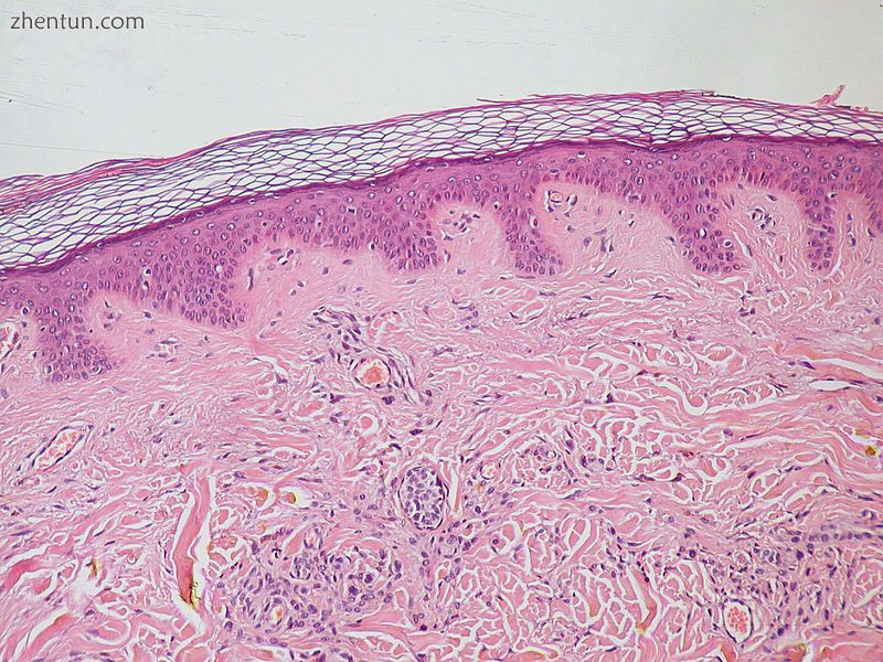 Normal Epidermis and Dermis with Intradermal Nevus 10x-cropped.JPG