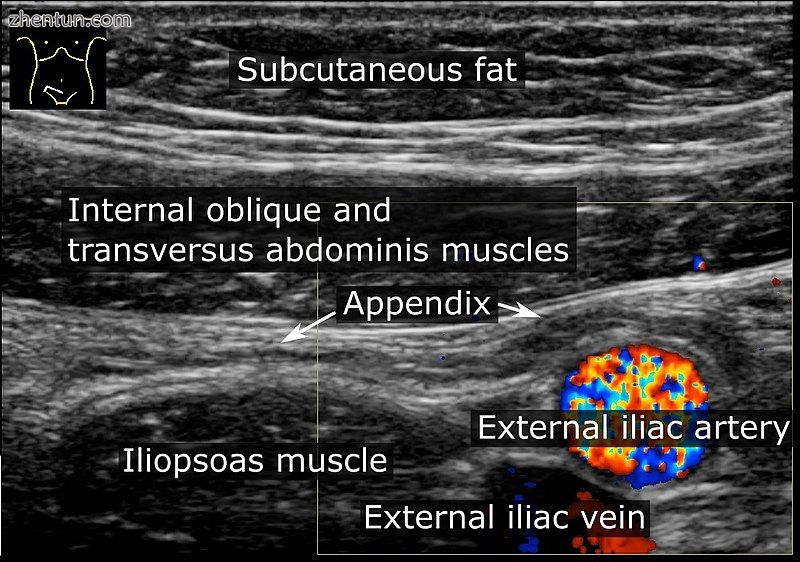 Abdominal ultrasound showing a normal appendix between the external iliac artery.jpg