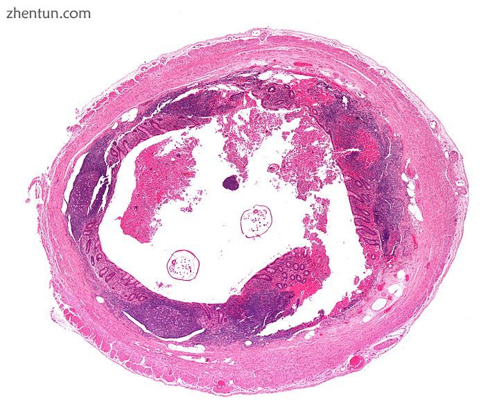 Cross section of the appendix with Enterobius with H&amp;E stain.jpg