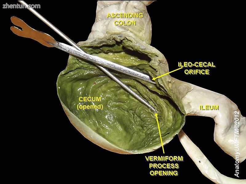 Ileo-cecal valve and vermiform appendix.jpg