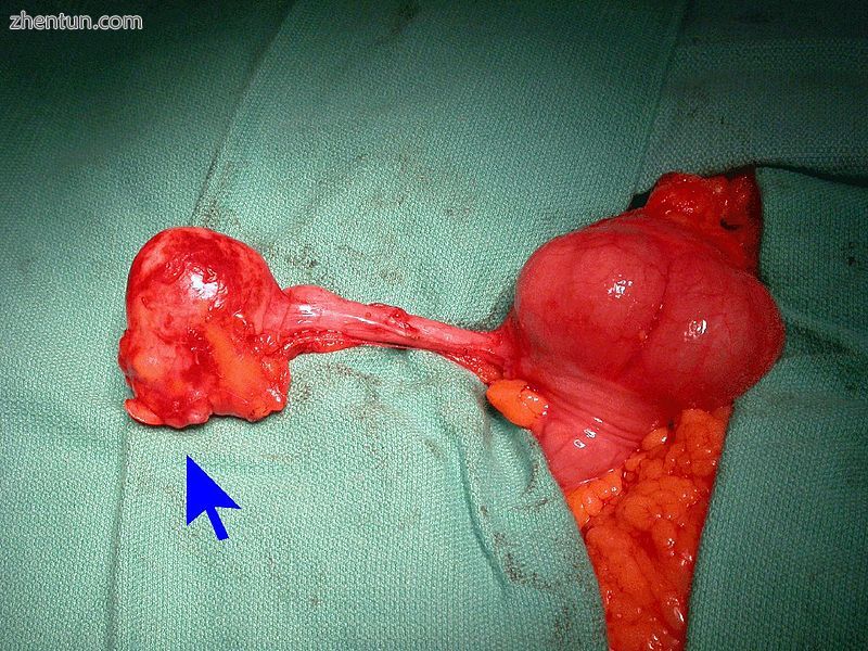 Mucinous adenocarcinoma of the appendix tip.jpg