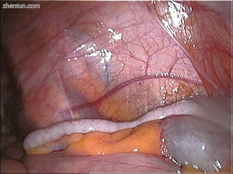 Vermiform appendix.jpg