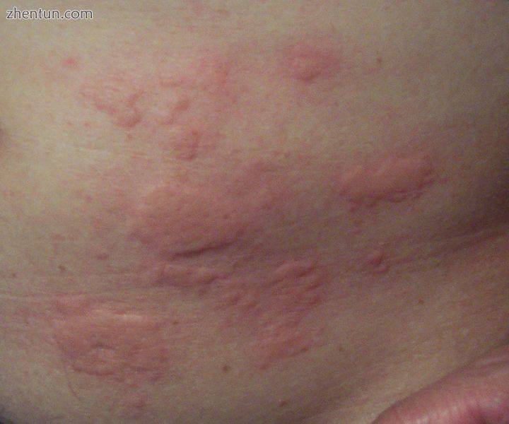 A typical rash.jpg