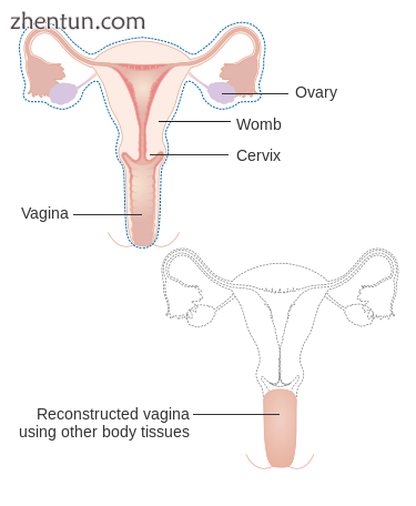 A radical hysterectomy for vaginal cancer with reconstruction of the vagina usin.png