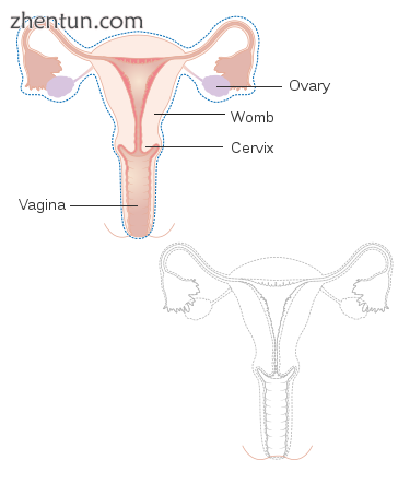 A radical hysterectomy to treat vaginal cancer without reconstruction.png