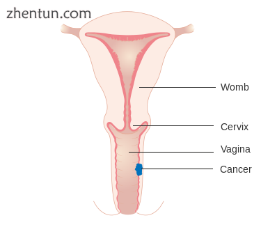 Stage 1 vaginal cancer.png