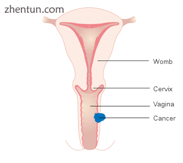Stage 2 vaginal cancer.png