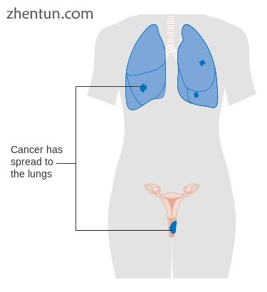 Stage 4B vaginal cancer.png