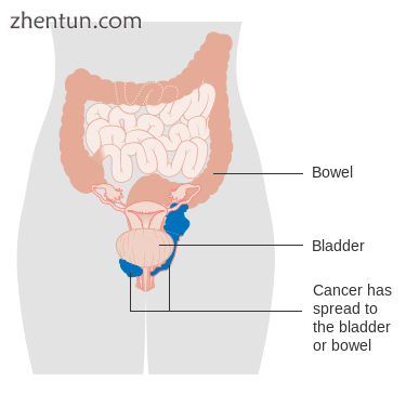 Stage 4A vaginal cancer.png