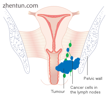 Stage 3 vaginal cancer.png