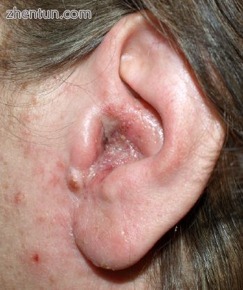A moderate case of otitis externa. There is narrowing of the ear channel, with a.jpg