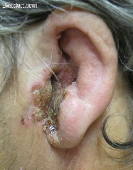 A severe case of acute otitis externa. Note the narrowing of the ear channel, th.jpg