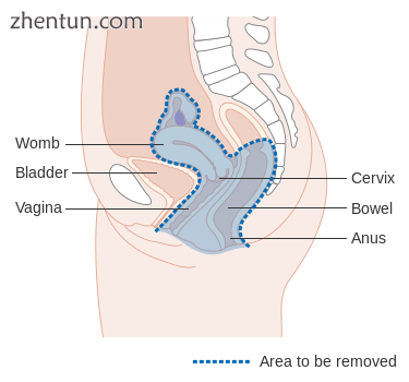 Diagram showing the area removed with a posterior surgery.png