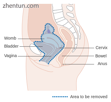 Diagram showing the area removed with an anterior operation.png