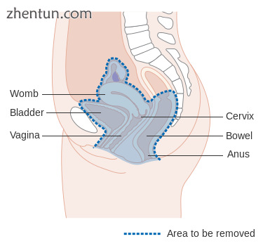 Diagram showing the area removed with a total operation.png