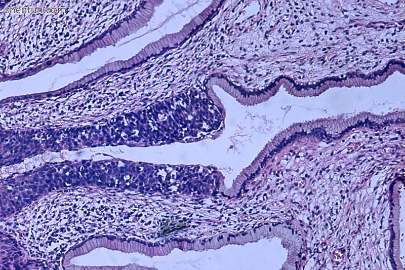Histopathologic image (H&amp;E stain) of carcinoma in situ (a.jpg