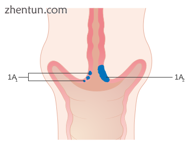 Stage 1A cervical cancer.png