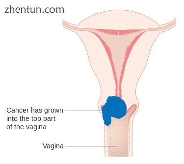 Stage 2A cervical cancer.png