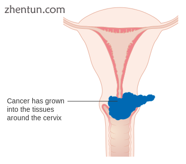 Stage 2B cervical cancer.png