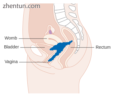 Stage 4A cervical cancer.png
