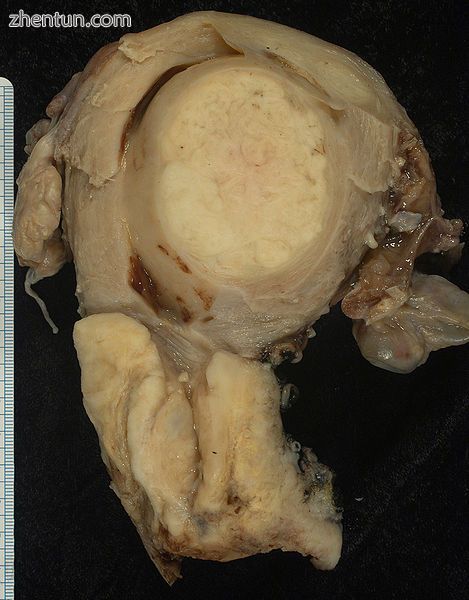 This large squamous carcinoma (bottom of picture) has obliterated the cervix and.jpg