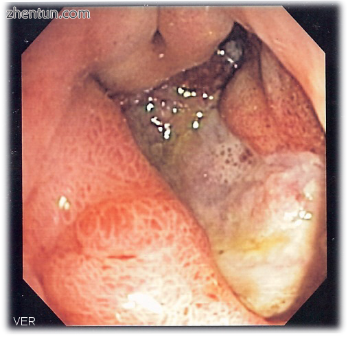 Deep gastric ulcer.png